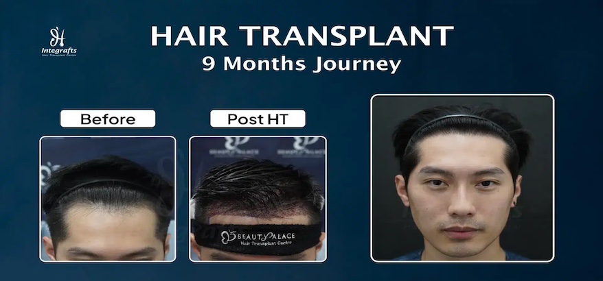 Sebelum Transplantasi Rambut, Kenali Dulu Hal-Hal yang Sering Terlewat